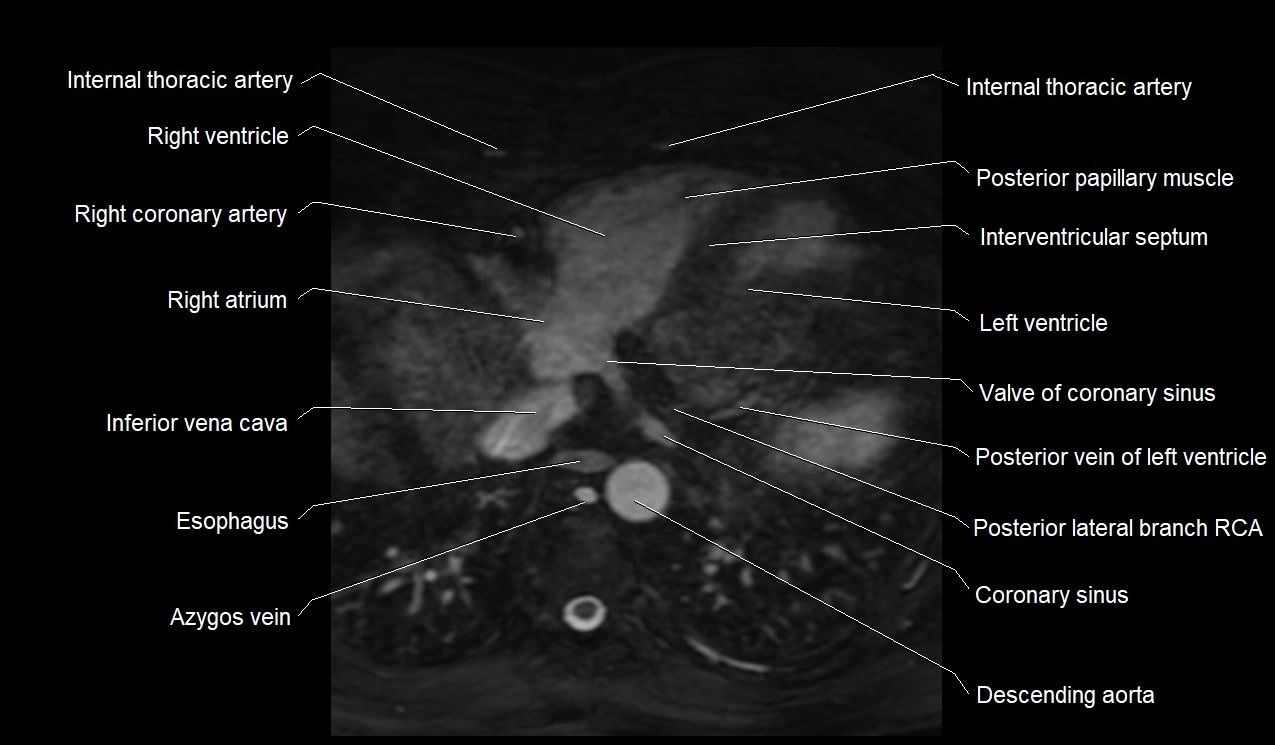 MRI heart coronary arteries and coronary veins anatomy axial image 36.webp